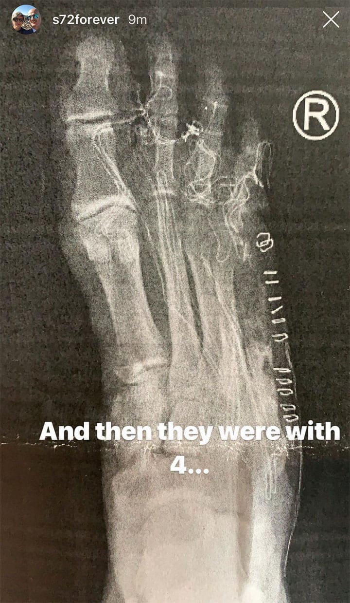 Stefan Everts shares an x-ray of toe amputation
