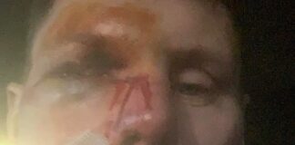 Brad Anderson suffers nasty facial injuries at Hawkstone Brad Anderson Hawkstone injuries