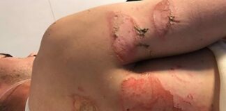 Graeme Irwin injury – in hospital burns unit and OUT for at least two GPs