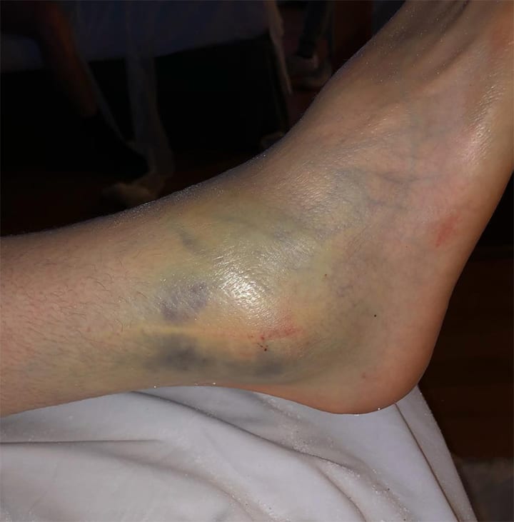 Romain Febvre's ankle injury from MXGP of Argentina