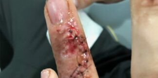 Adam Sterry injury update Adam Sterry Argentina finger injury 2018