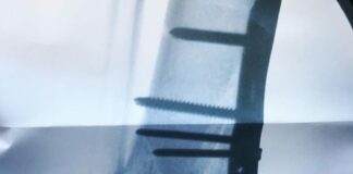 Josh Grant injury update – posts x-ray following surgery