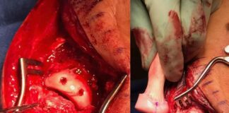 Injury Update: Ken Roczen shares another graphic surgery