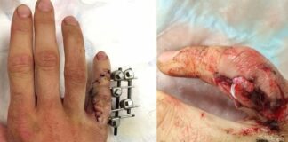 Jake Nicholls on MXGP injury list but lucky to keep finger