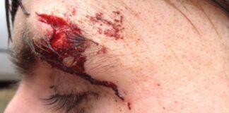 Jake’s stitched up!