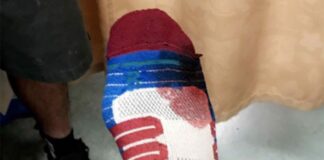 Jason Anderson injury update – compound fracture