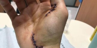 Jordi Tixier injury – surgery on snapped hand tendon (warning: graphic content) Jordi Tixier surgery 2018