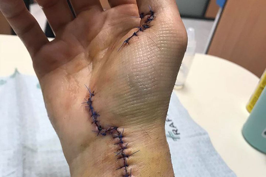 Jordi Tixier surgery 2018