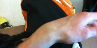 Roczen breaks arm