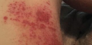 AMA responds to rider anger following San Diego Supercross chemical burns