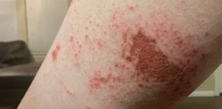 San Diego Supercross lime controversy: Safety of riders, teams and crew ‘top priority’ says Feld Entertainment Vann Martin lime skin irritation after San Diego Supercross