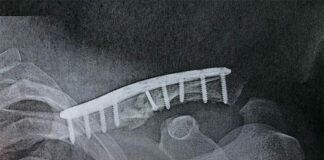 Tommy Searle injury update – successful surgery