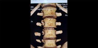 Toni Bou injury – fractured vertebrae Toni Bou