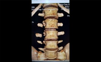 Toni Bou injury – fractured vertebrae Toni Bou